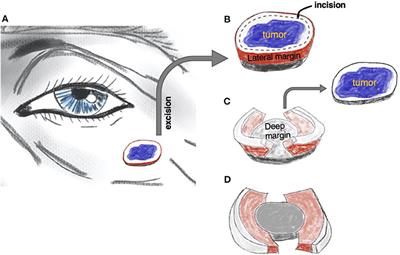 Muffin Technique Micrographic Surgery for Non-melanoma Skin Cancer